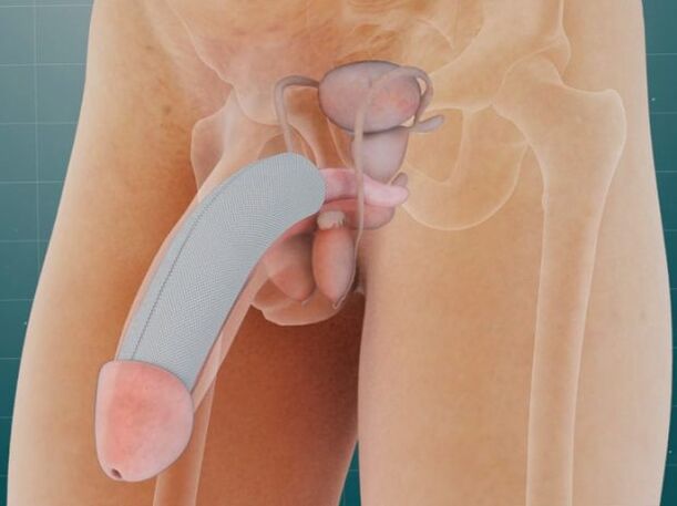 A pénisz bevezetése után egy speciális implantátum a bőr alá