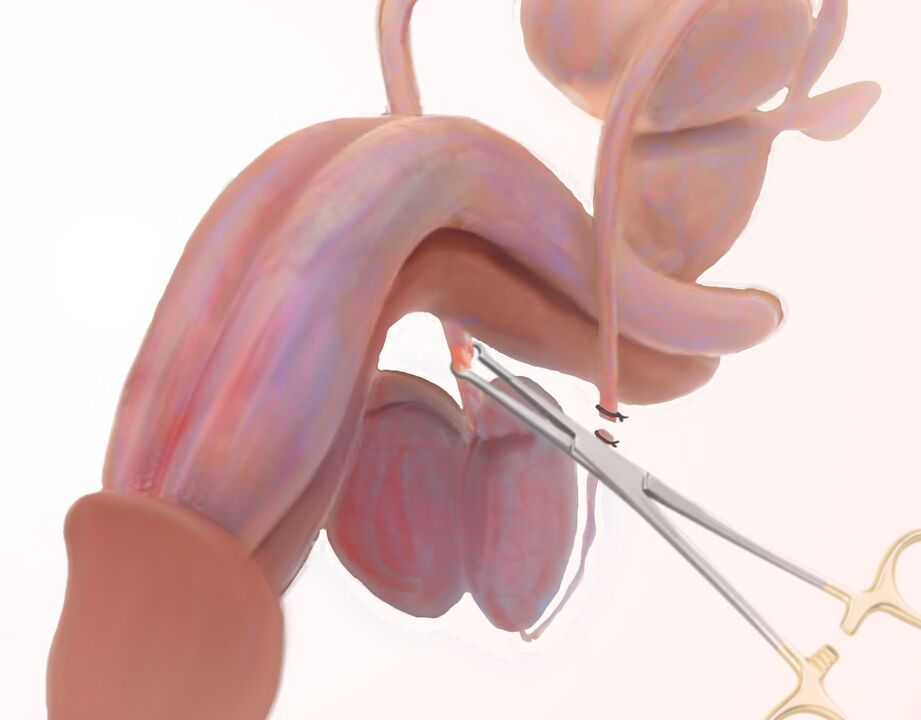ligamentotomia a pénisz megnagyobbítására
